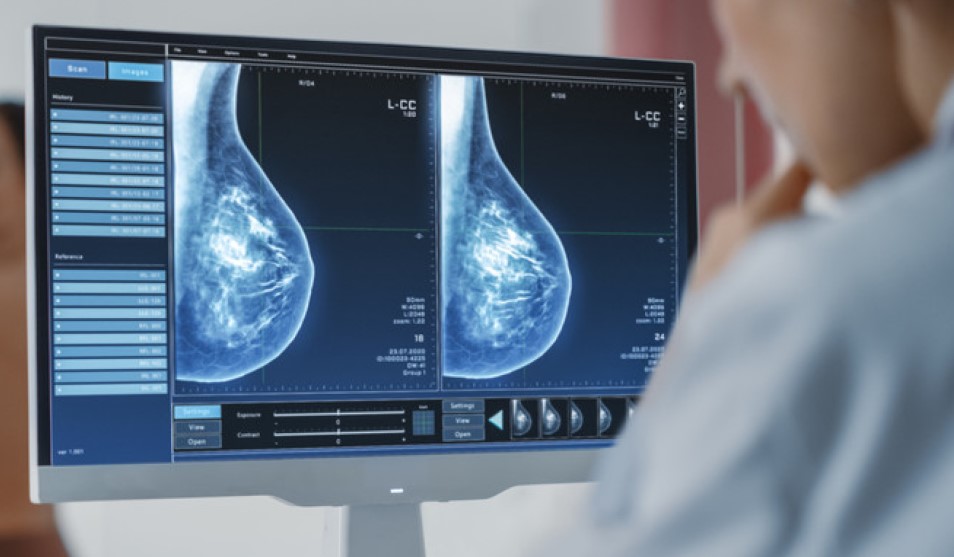 Radiation Therapy for Breast Cancer